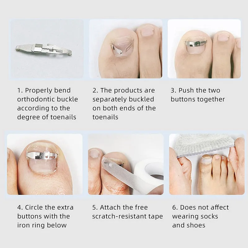 Professional Ingrown Toenail Treatment Corrector